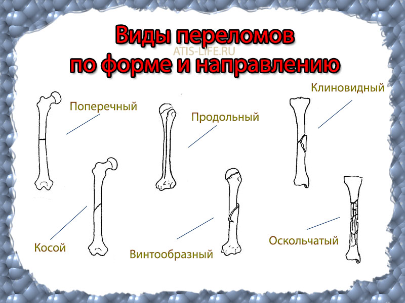 Анатомия человека переломы костей thumbnail